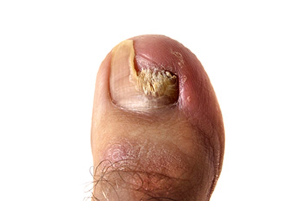 The Hidden Struggles of Fungal Toenails
