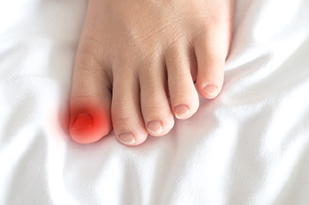 Podiatric Care for Your Ingrown Toenail
