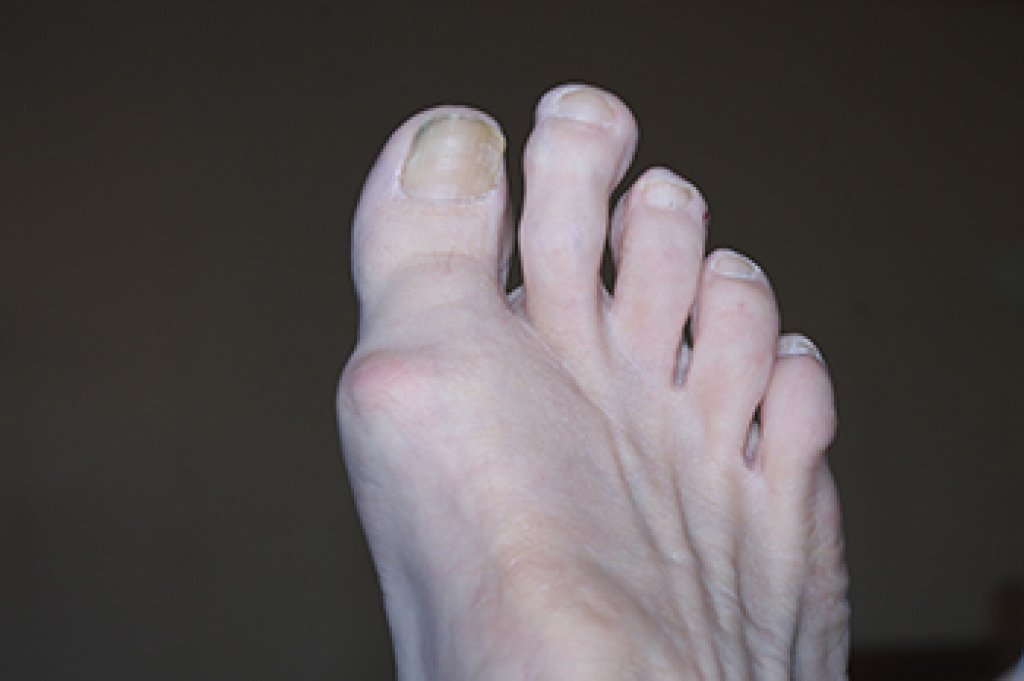 What Is Capsulitis of the Second Toe?
