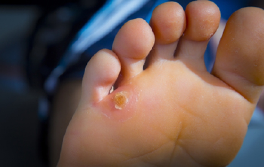 Understanding and Treating Painful Foot Corns