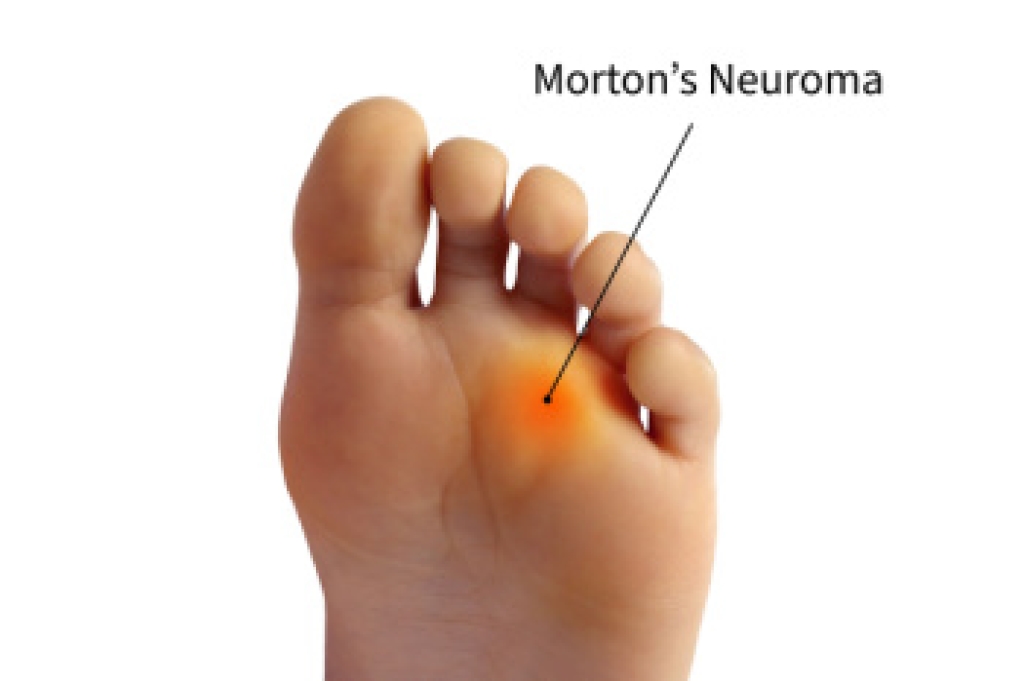 Understanding Morton’s Neuroma