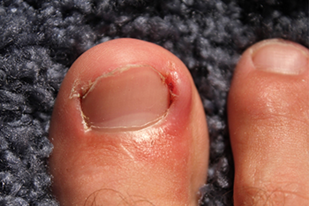 Nail Growth and Ingrown Toenails