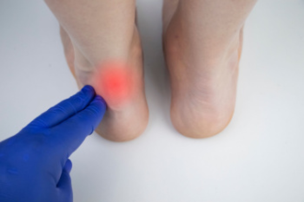 Understanding the Achilles Tendon and How It Heals