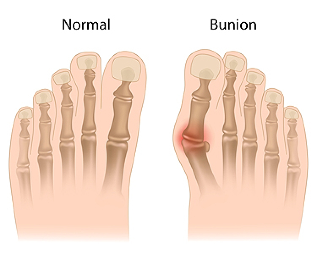 What Can Cause a Bunion to Develop?