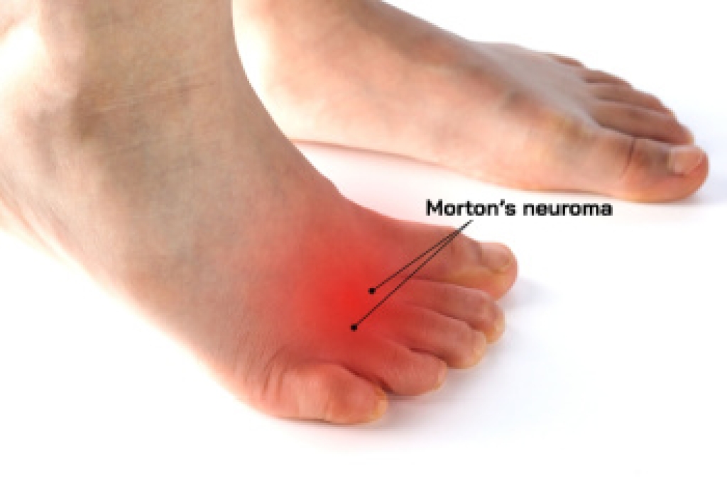 Finding Relief From Morton’s Neuroma