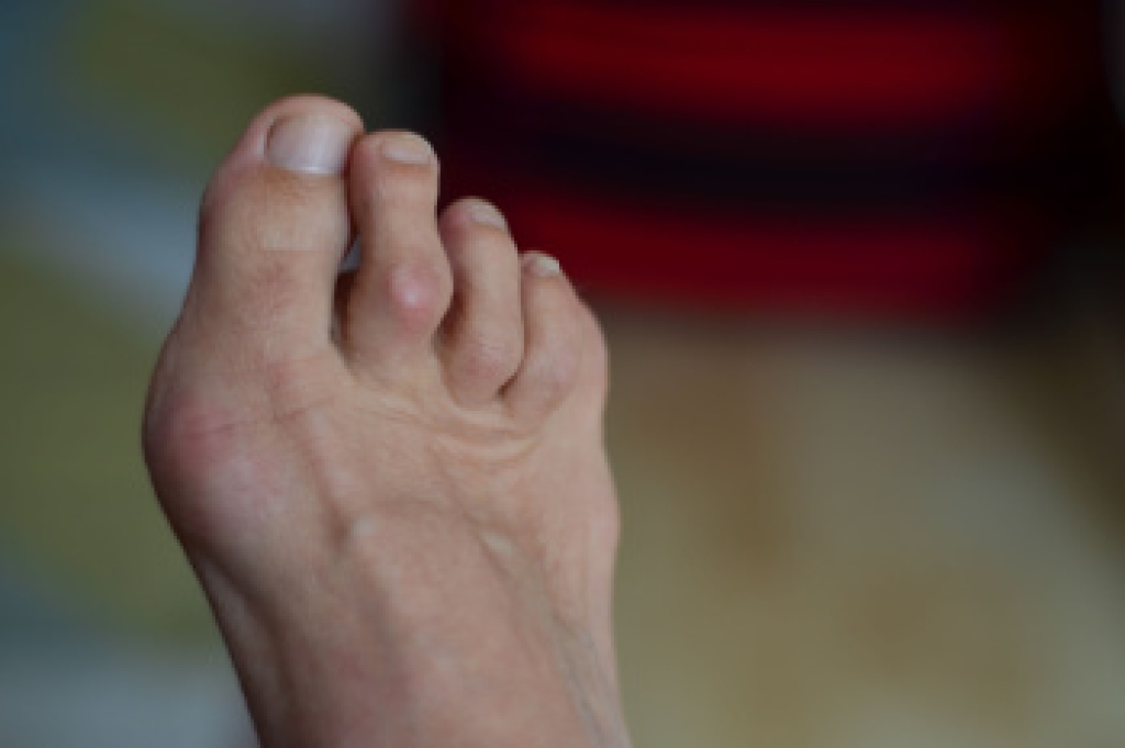 Most Hammertoes Start With Muscle Imbalance