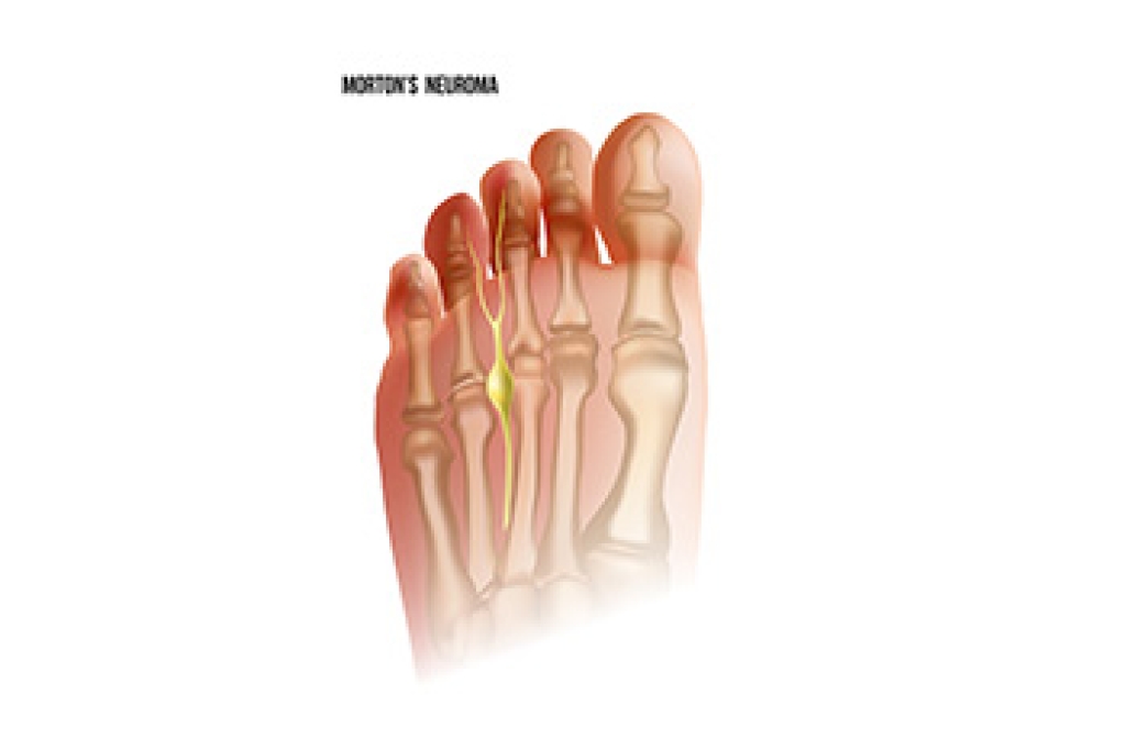 Causes and Symptoms of Morton’s Neuroma